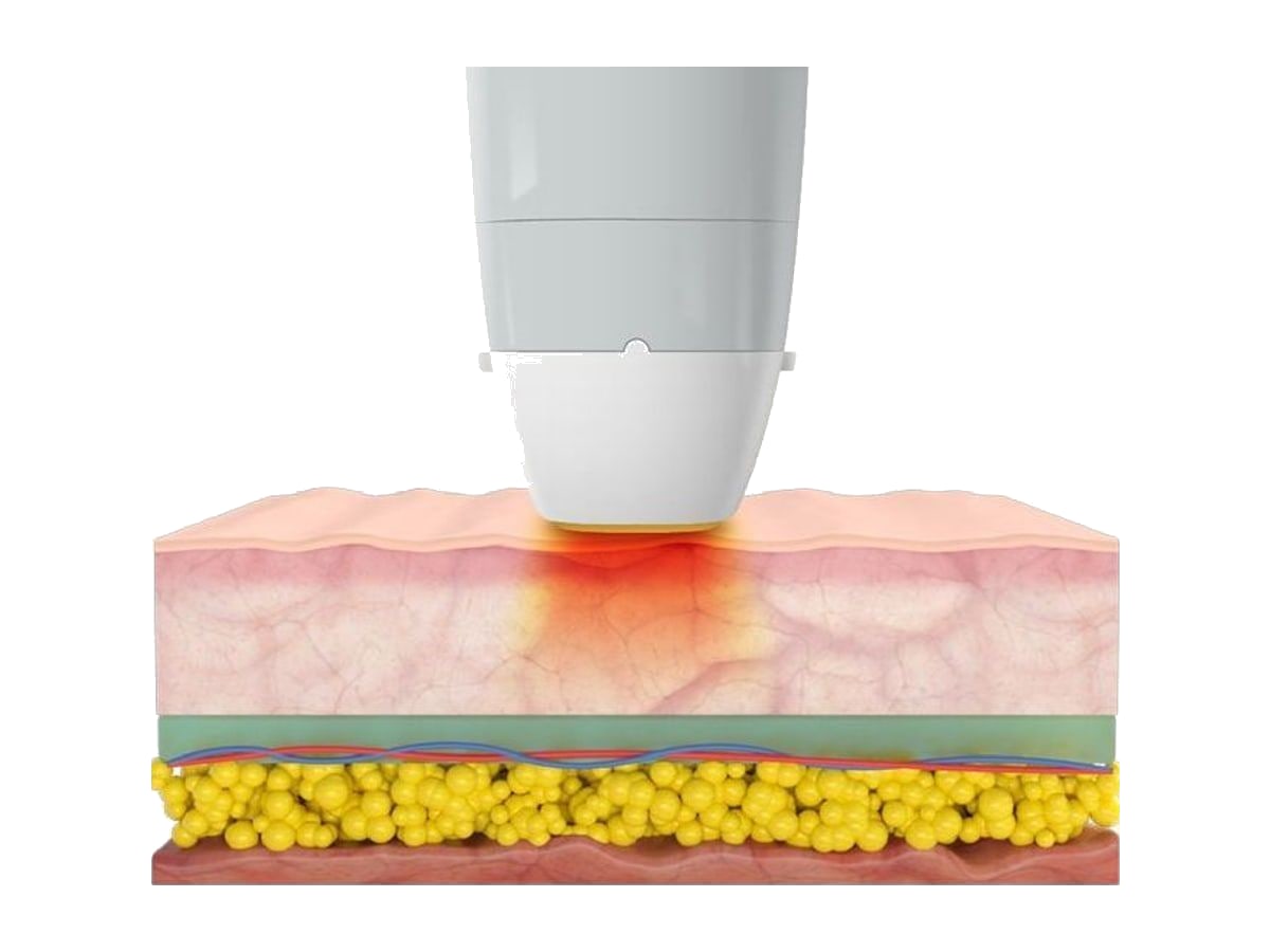NTTS Thermal Transfer